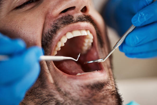 Dental Inlays and Onlays in Yorktown Heights, NY